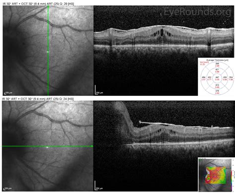 Atlas Entry - The Sympathizing Eye: Panuveitis Secondary to Sympathetic ...