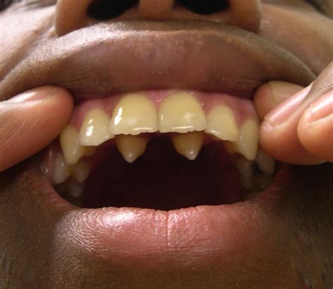 How Freddie Mercury got his voice: It wasn't his teeth | Genetic ...