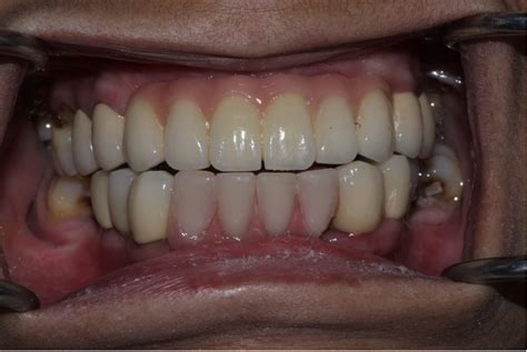 Tooth Replacement | Merchant Dental