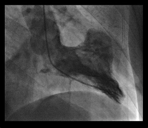 A left ventricular aneurysm due to an occluded ‘end artery’ in a rare ...