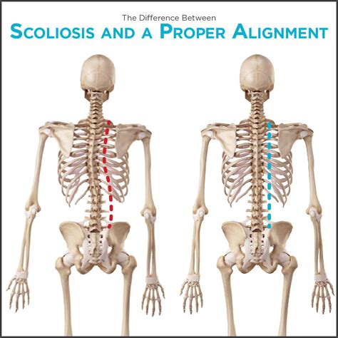Scoliosis