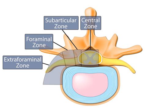 The Difference Between Bulging Disc and Herniated Disc