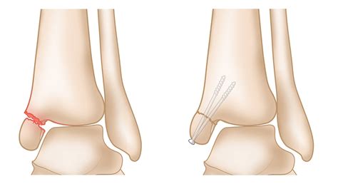 Medial Malleolus Fracture Recovery Time