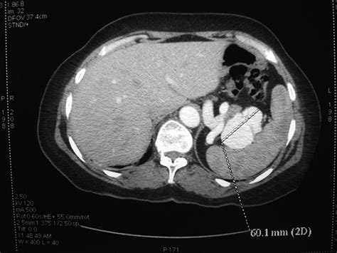 Splenic artery aneurysm: pre-rupture diagnosis is life saving | BMJ ...
