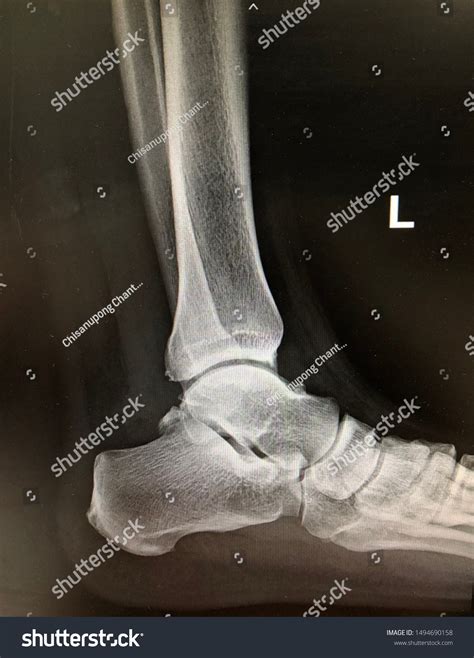 X Ray Ankle Ap