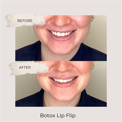 Care Esthetics Fargo | A lip flip with Botox is a cosmetic procedure designed to enhance the ...