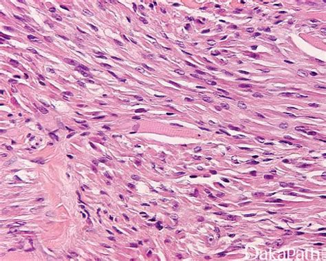 胚胎型横纹肌瘤