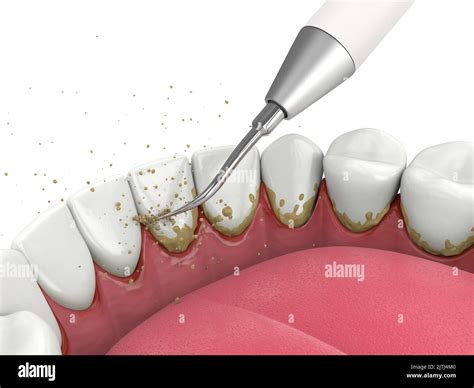 Removing tartar and plaque from teeth by ultrasonic scaler. Dental descaling concept Stock Photo ...