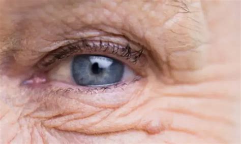 Continuous Use of Tear Substitutes Improves Dry Eye in Age-related ...