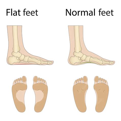 Flat Feet And Normal Feet Outlet | bellvalefarms.com