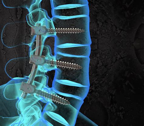 What Is Lumbar Spinal Fusion at James Reis blog