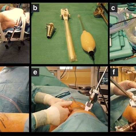 Image result for Retroperitoneal Approach Nephrectomy