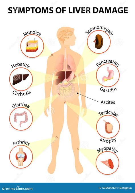 Symptoms of Liver Disease stock vector. Illustration of gallbladder - 53960303