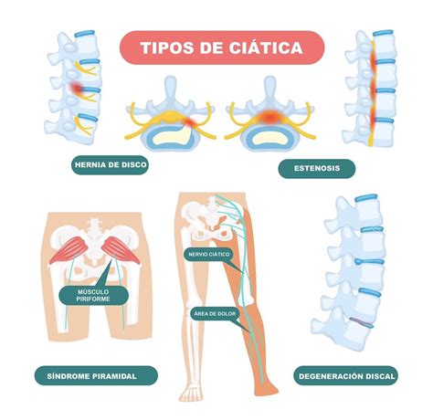 Ciática: síntomas, causas y cómo tratarla eficazmente