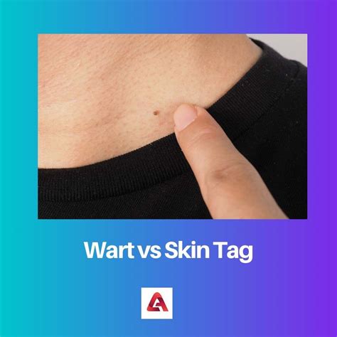 Skin Tag Vs Wart Inner Thigh at Tommy Lotts blog