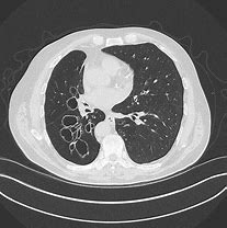 Image result for Cystic Bronchiectasis Radiology