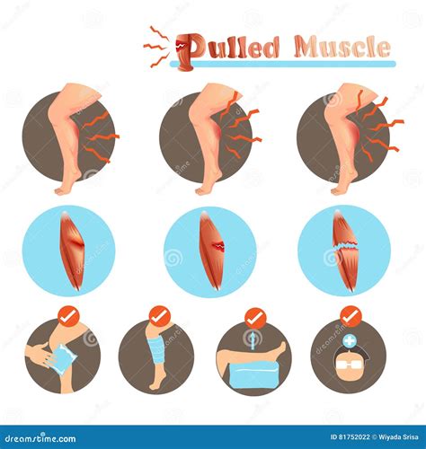 Therapy For Pulled Muscle