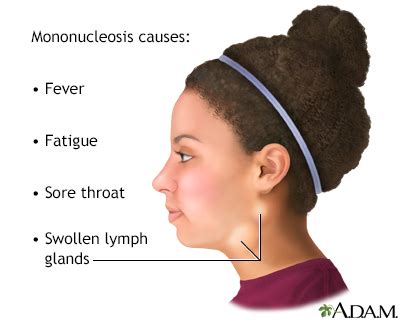 Mononucleosis Symptoms, Doctors, Treatments, Advances & More | MediFind