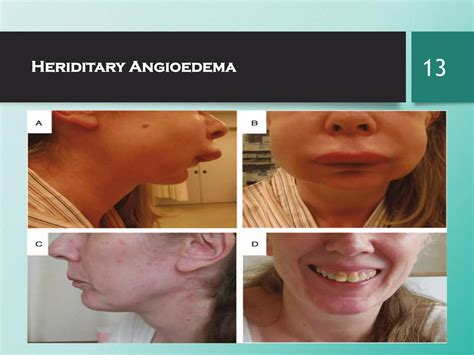 Hereditary angioedema | PDF