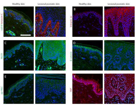 Mechanotransduction in Skin Inflammation