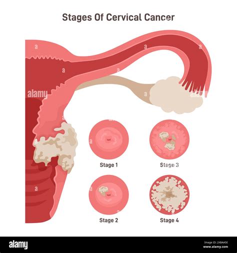 Human cervix hi-res stock photography and images - Alamy