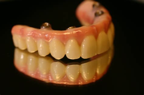 Implant Supported Dentures - Ueckert Dentistry