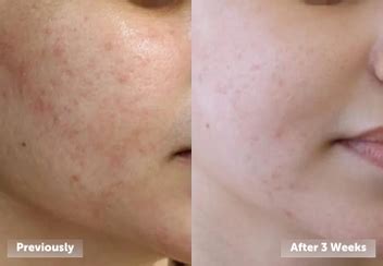 LAURITZ | Unique biotechnology for skin health and beauty