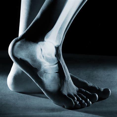 Plantar Fasciitis Surgery - West Coast Orthopedics