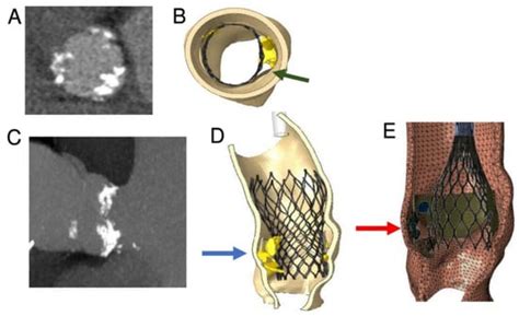 A Finite Element Analysis Study from 3D CT to Predict Transcatheter ...