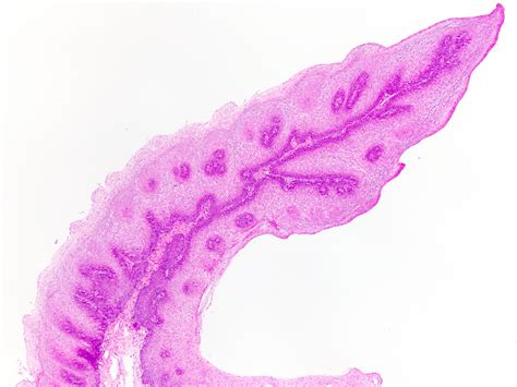 Pathology Outlines - Squamous papilloma