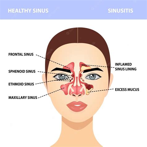 Are Sinus Infections Contagious - Comtriokini
