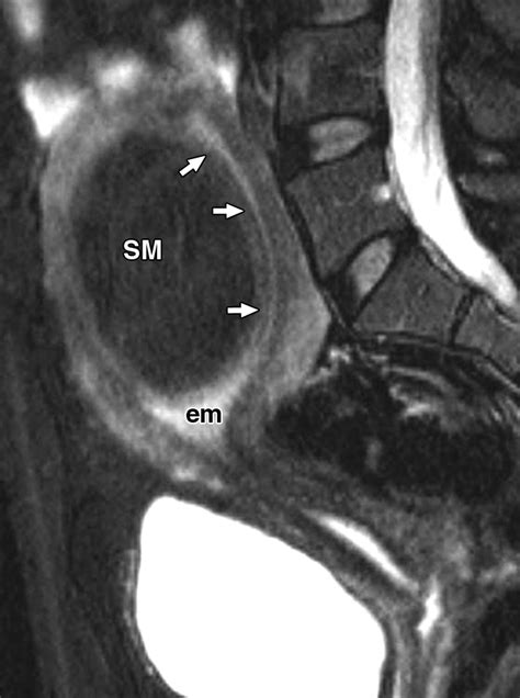 Submucosal Fibroids Becoming Endocavitary Following Uterine Artery ...
