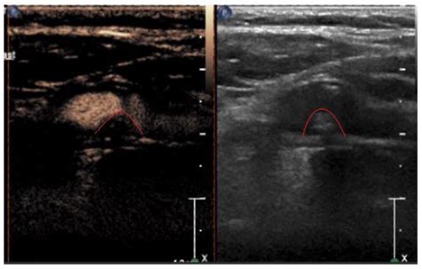 Assessment of Plaque Characteristics by Contrast-Enhanced Ultrasound ...