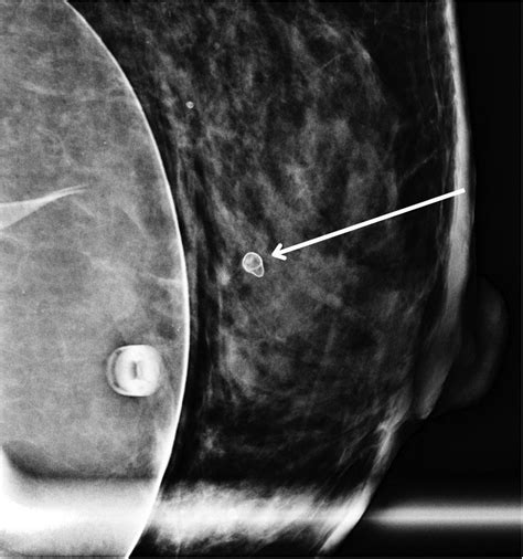 Fat necrosis in the breast: a multimodality imaging review of its ...