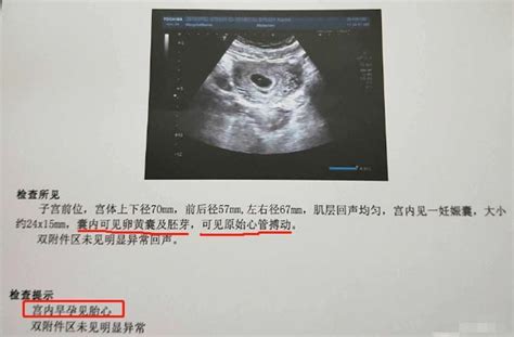 孕8周后，若B超单上四个指标过关＝胎儿发育很安稳，基本不会流产