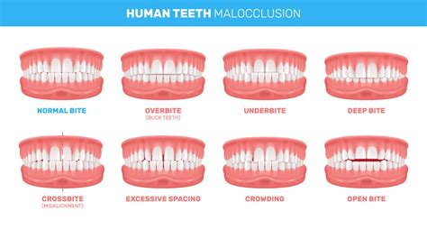Dental Malocclusion Classification at Esther Hunt blog