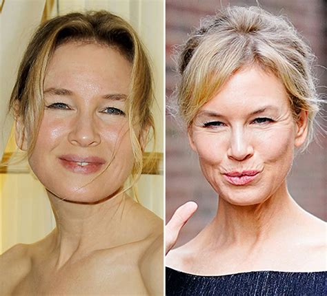 Renee Zellweger Face Surgery