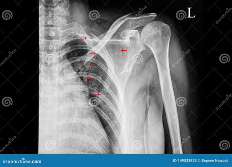 A Shoulder Xray Film Showing Fractured Second To To Fifth Ribs with ...