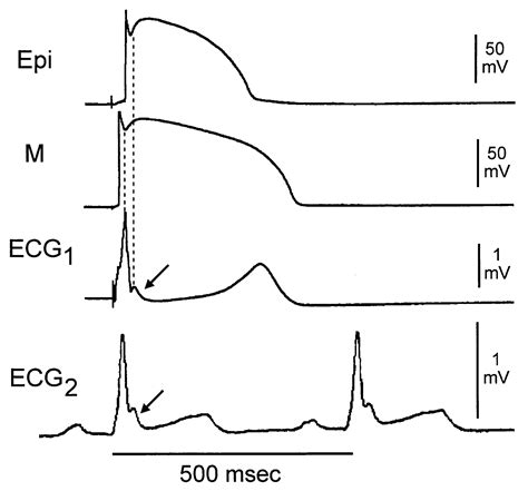 Cellular Basis for the Electrocardiographic J Wave | Circulation