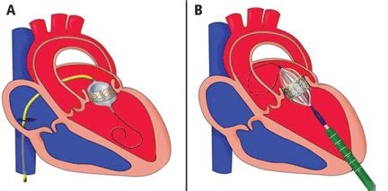 Pacemaker Procedure 的图像结果