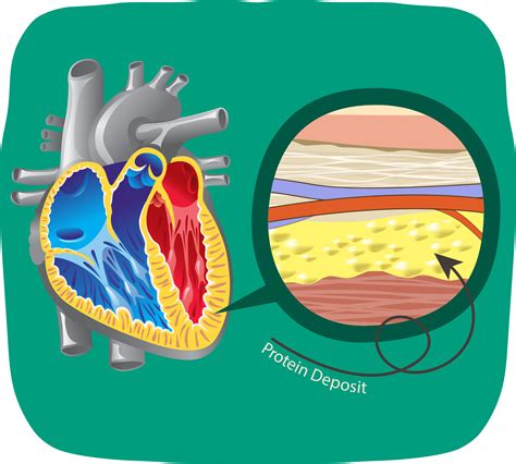 Transthyretin Amyloid Cardiomyopathy (ATTR-CM)
