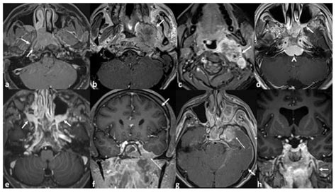 Radiologic Predictors of Disease Recurrence in Nasopharyngeal Carcinoma ...