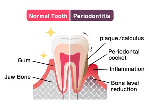 Periodontal Disease Stages, Symptoms, and What To Expect