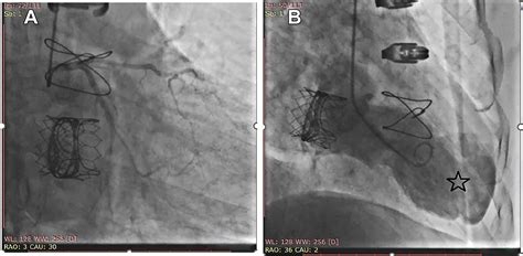 Conservative Management of an Iatrogenic Left Ventricular Aneurysm With ...