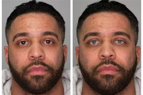 Eye Color Change Surgery in Iran Before After photos | MedPalTrip