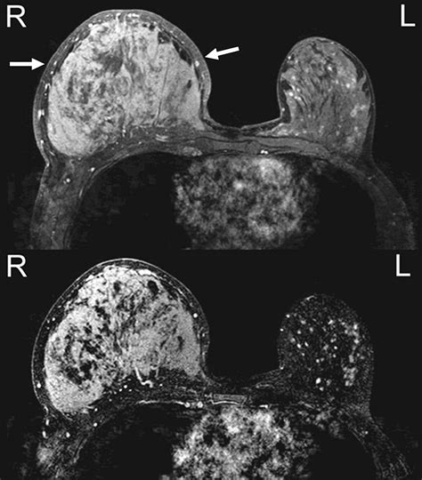 What Does Inflammatory Breast Cancer Look Like On Mri at Linda Lara blog