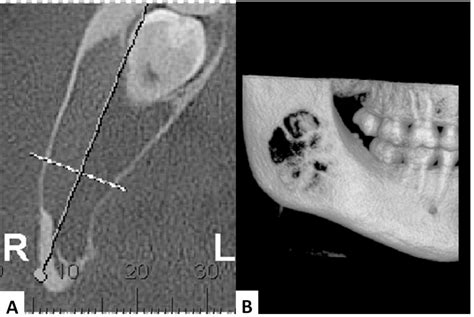 SciELO Brasil - Atypical traumatic bone cyst involving impacted lower ...