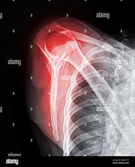 X-ray Shoulder joint shoulder transcapular view for diagnosis fracture ...