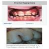 Difference between enamel hypoplasia and incipient caries - Brainly.in