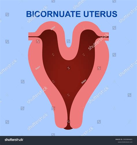 Bicornuate Uterus Congenital Malformation That Occurs Stock Vector ...